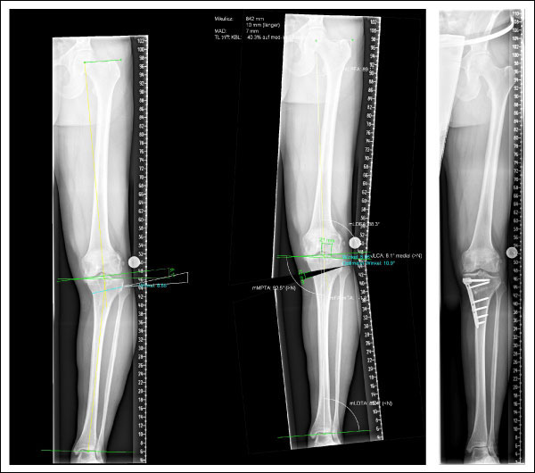 Knie: Arthrose / Roland-Klinik