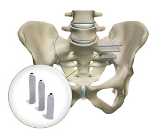 Ein besonders 
innovativer, dreieckiger Implantat-Typus stammt aus dem 3D-Drucker