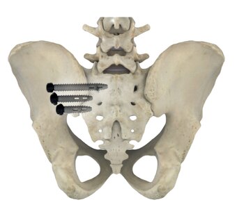 Mittels Titan-Schrauben kann das
Iliosakralgelenk dauerhaft stabilisiert werden